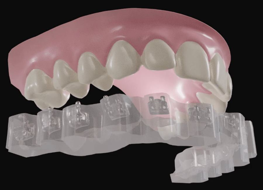 DIBS AI scan of an upper row of of teeth with braces floating just below.